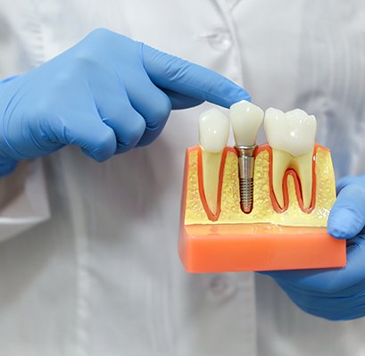 Dentist in blue gloves holding sample implant pointing to crown