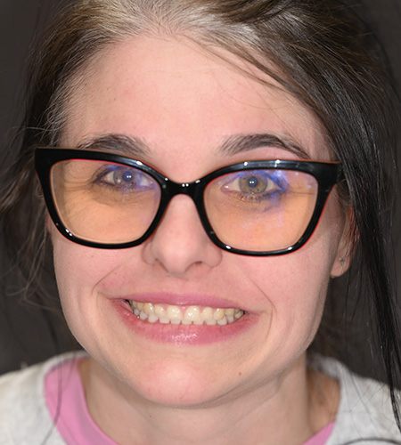 Man smiling before dental treatment