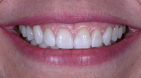 Close up of teeth after treatment