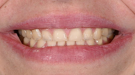 Close up of teeth prior to treatment