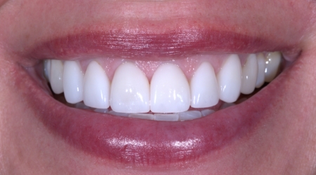 Close-up of smile after teeth have been fixed
