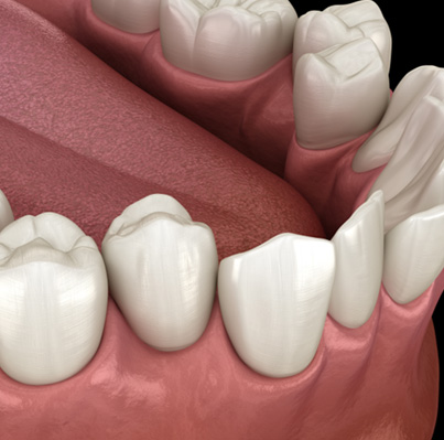 Illustration of crowded teeth