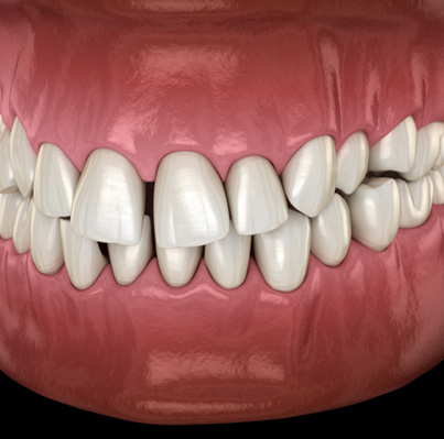 Illustration of gapped teeth