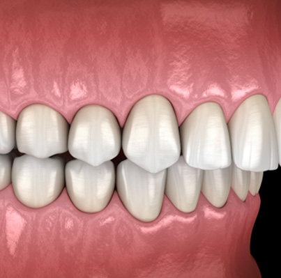 Illustration of an overbite