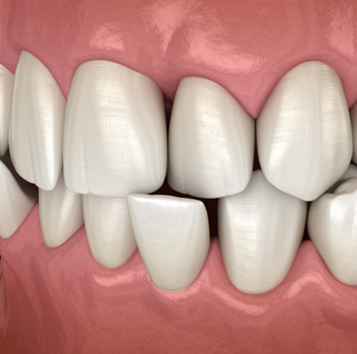 Illustration of a crossbite