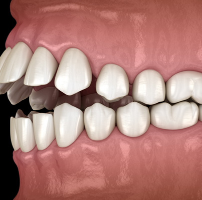 Illustration of an open bite