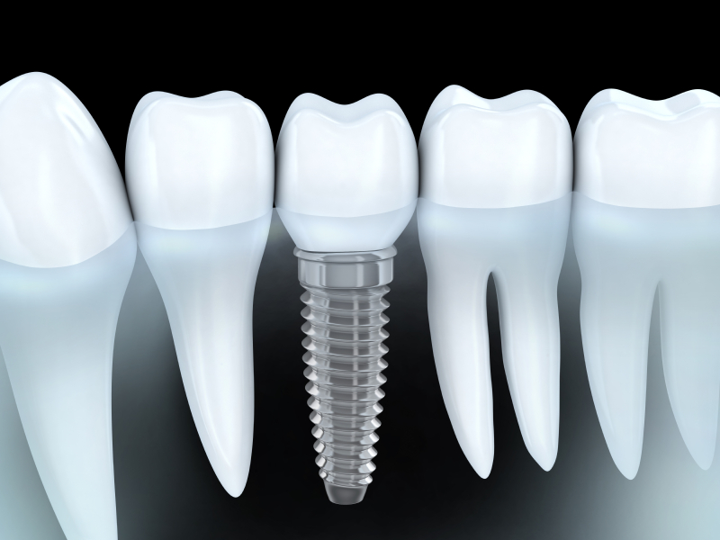 Your dentist in OKC, Dr. Mitchell, allows you to invest in your oral health with dental implants.